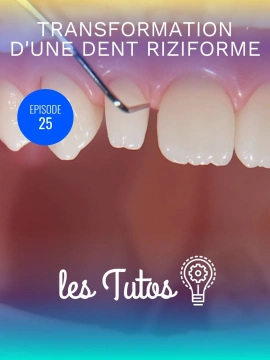 Transformation d'une dent riziforme