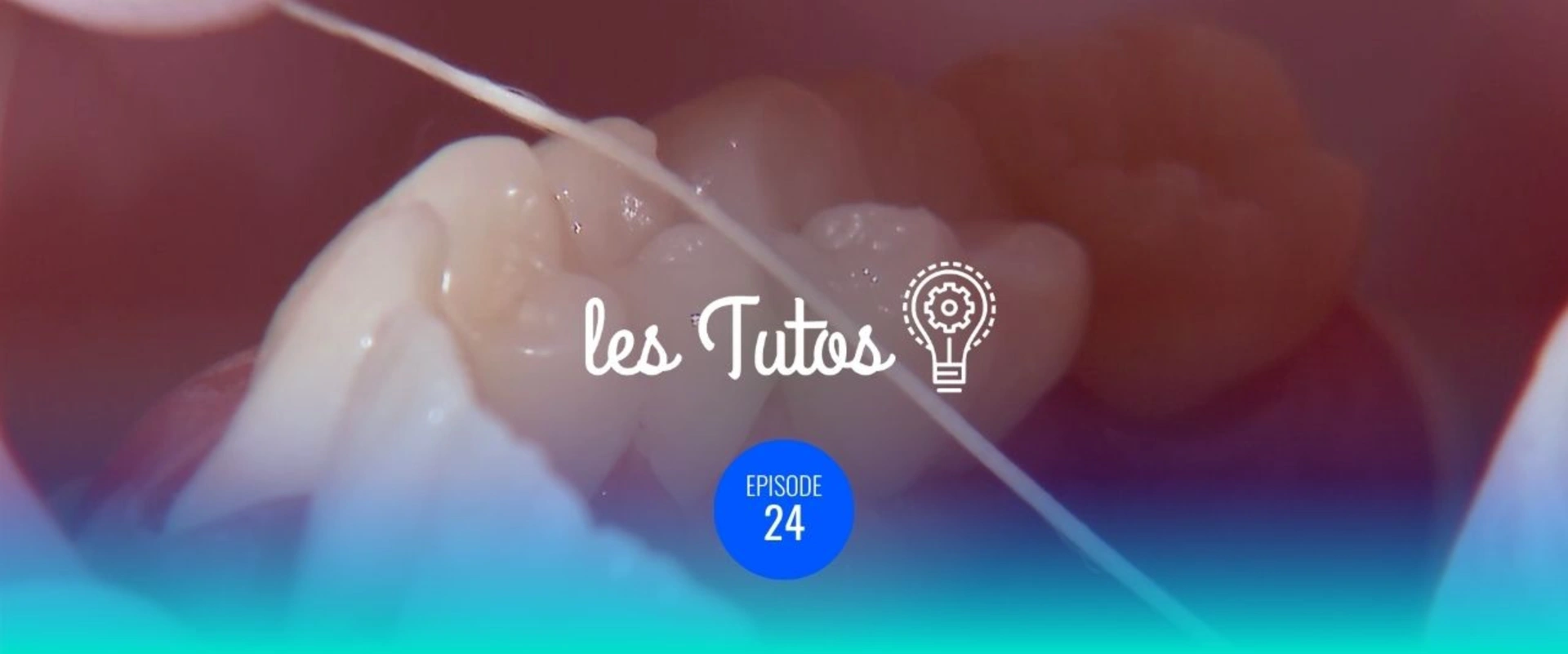 Pose de la digue Isolation d'une pré-molaire (45)