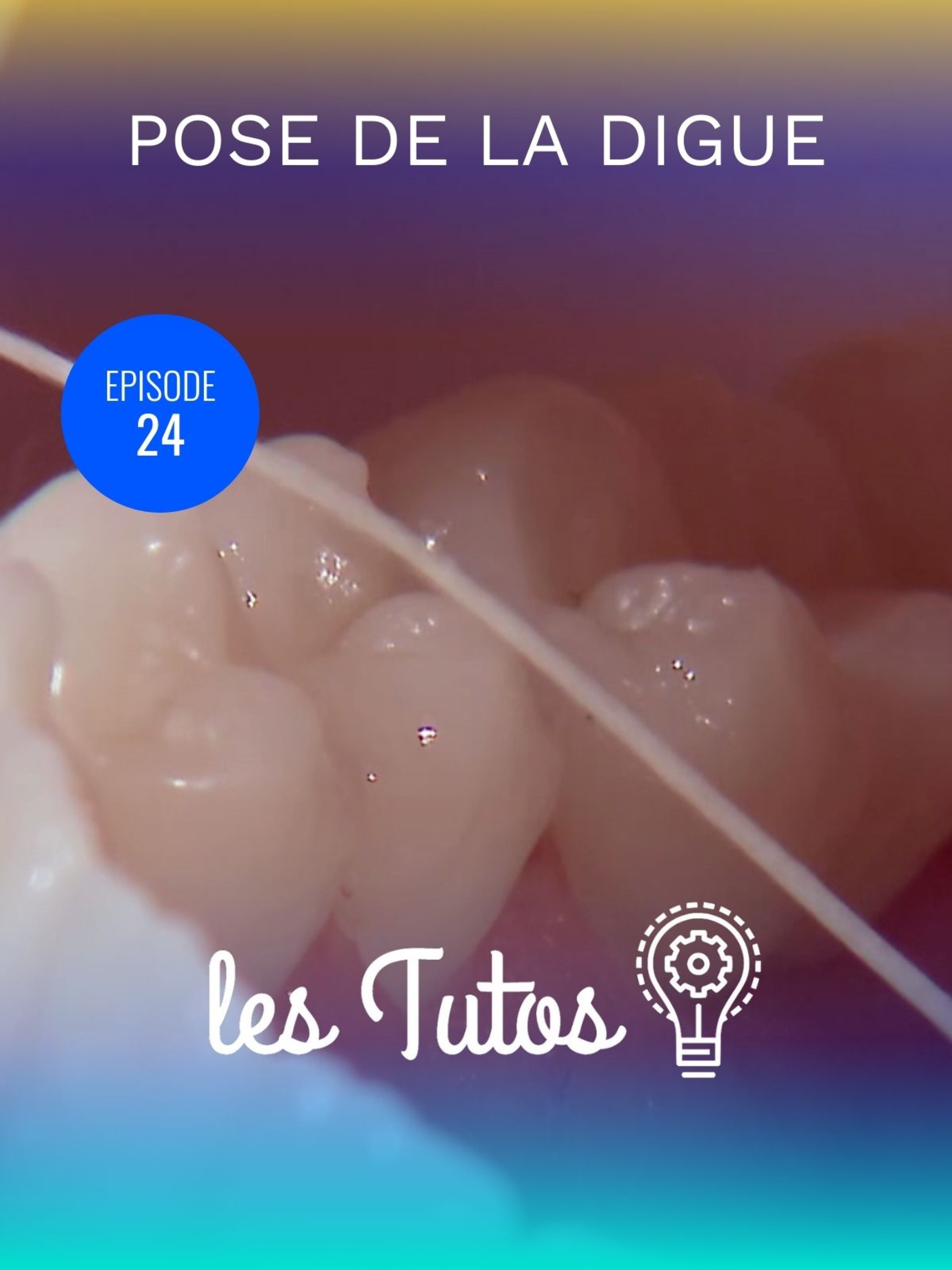 Pose de la digue Isolation d'une pré-molaire (45)