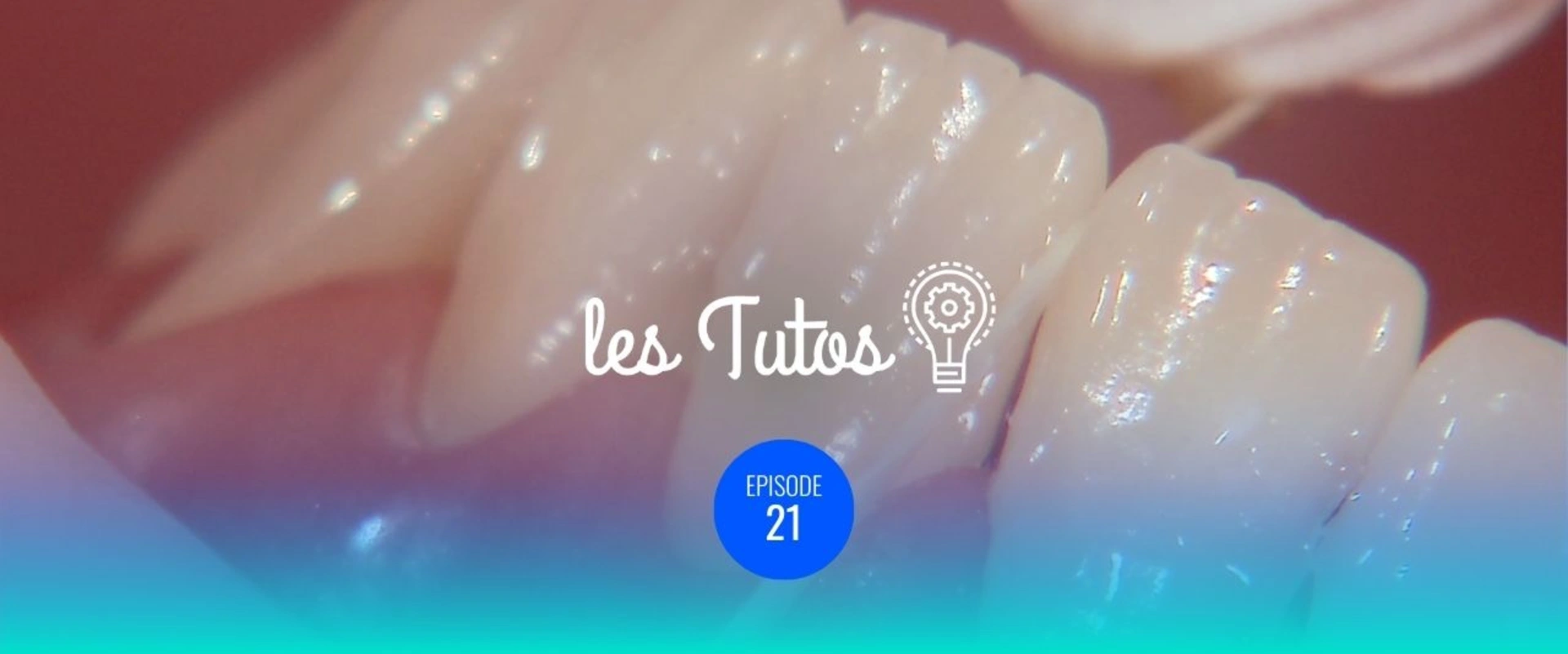 Pose de la digue Isolation du bloc antérieur (34 à 44)