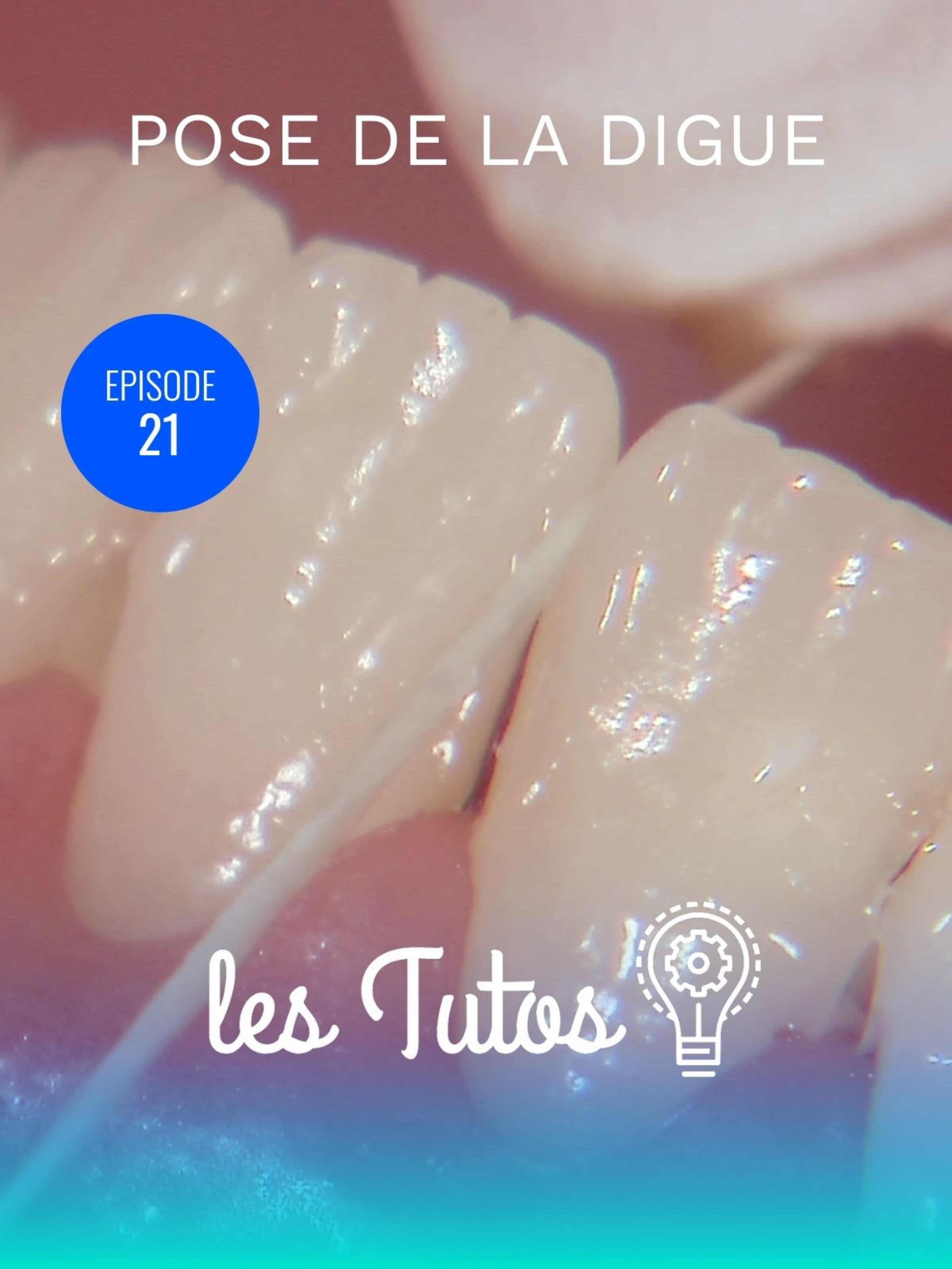 Pose de la digue Isolation du bloc antérieur (34 à 44)