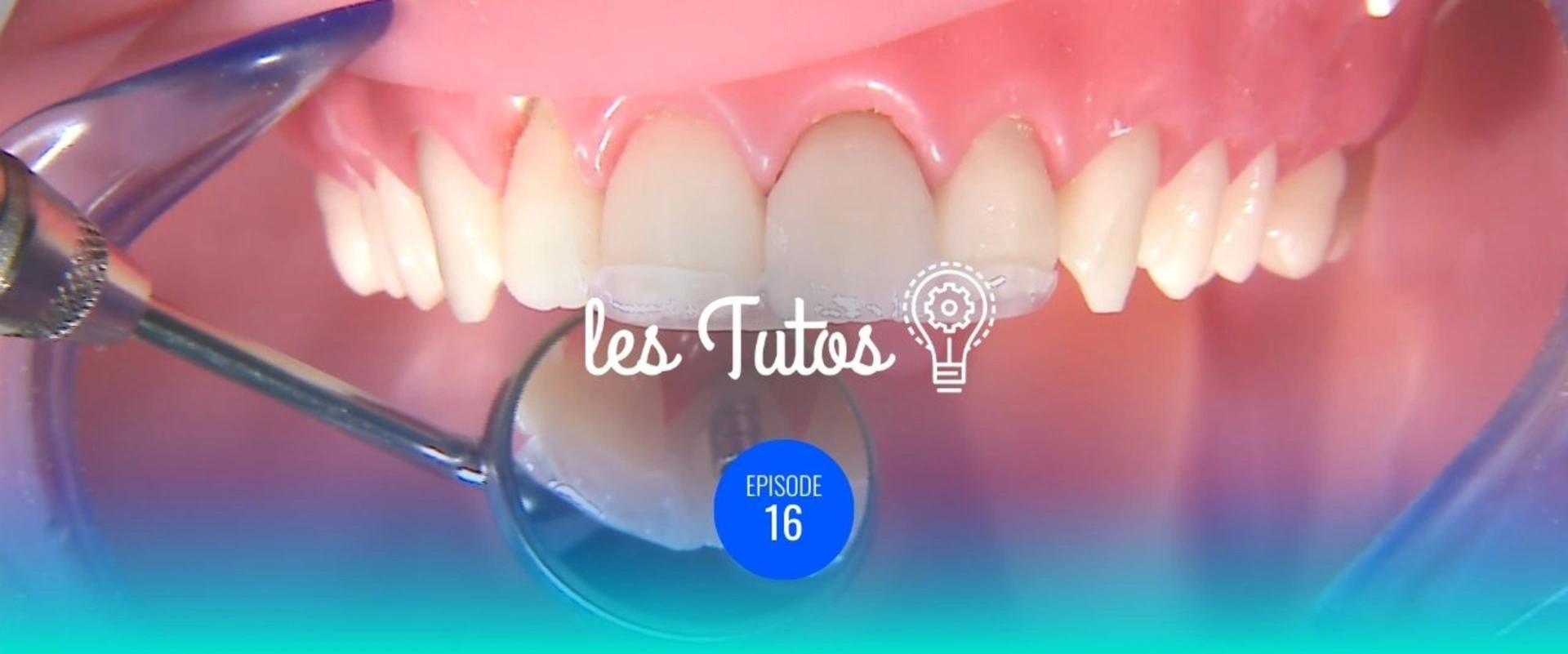 Réalisation d'une coiffe transitoire immédiate à l'aide du guide chirurgical