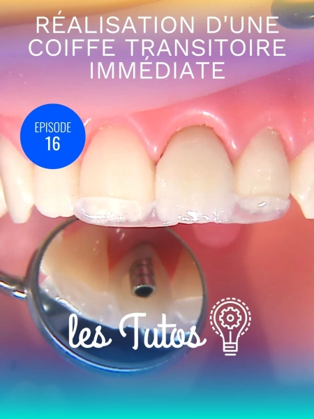 Réalisation d'une coiffe transitoire immédiate à l'aide du guide chirurgical