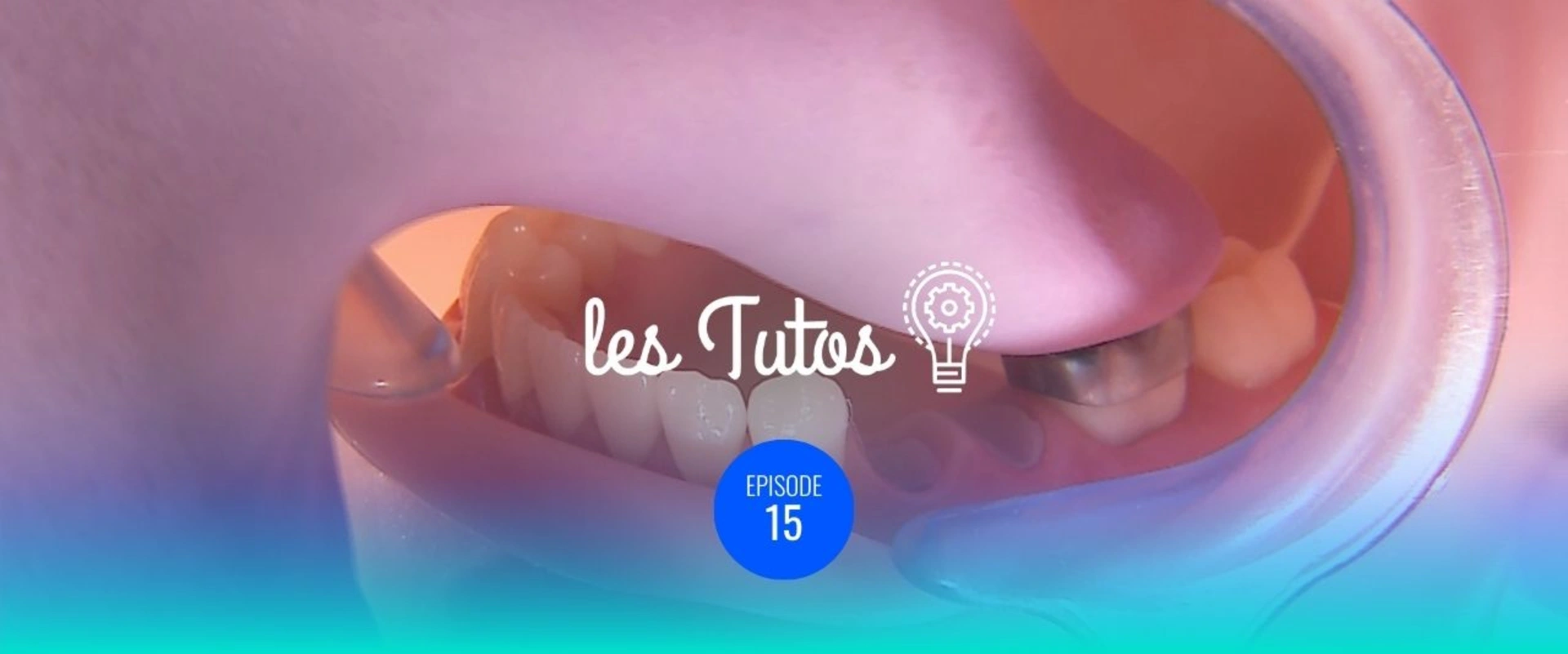 Transfert bague orthodontique pour bridge tobbi