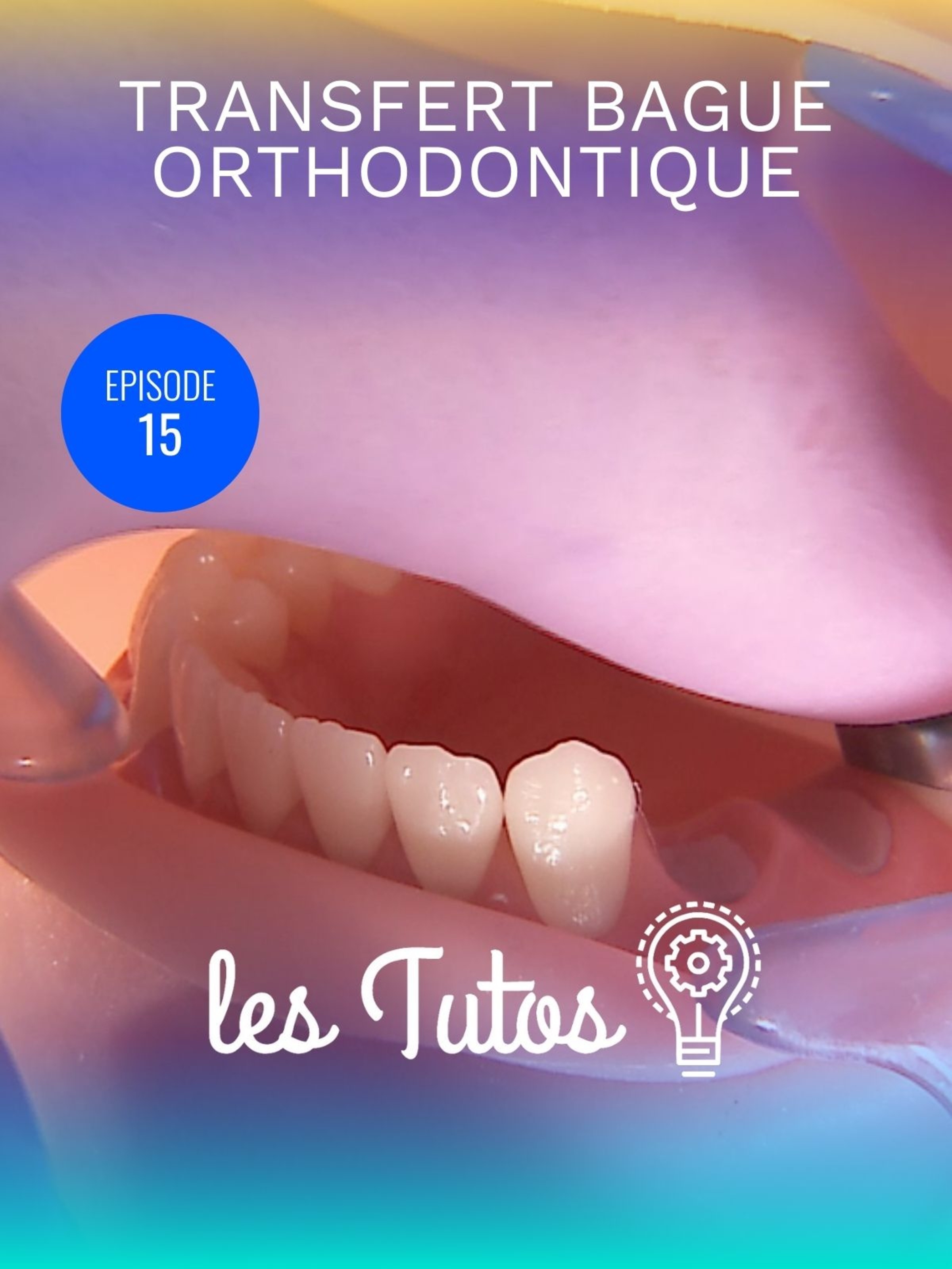 Transfert bague orthodontique pour bridge tobbi