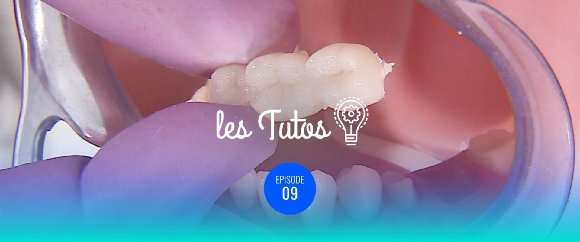 Renforcement bridge temporaire fibres de verre