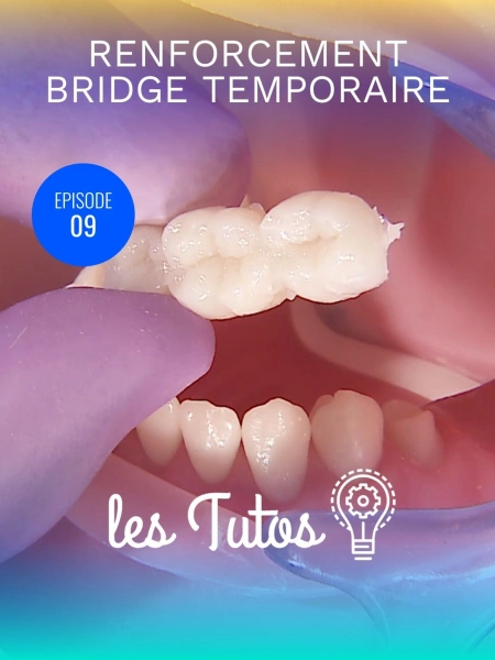 Renforcement bridge temporaire fibres de verre