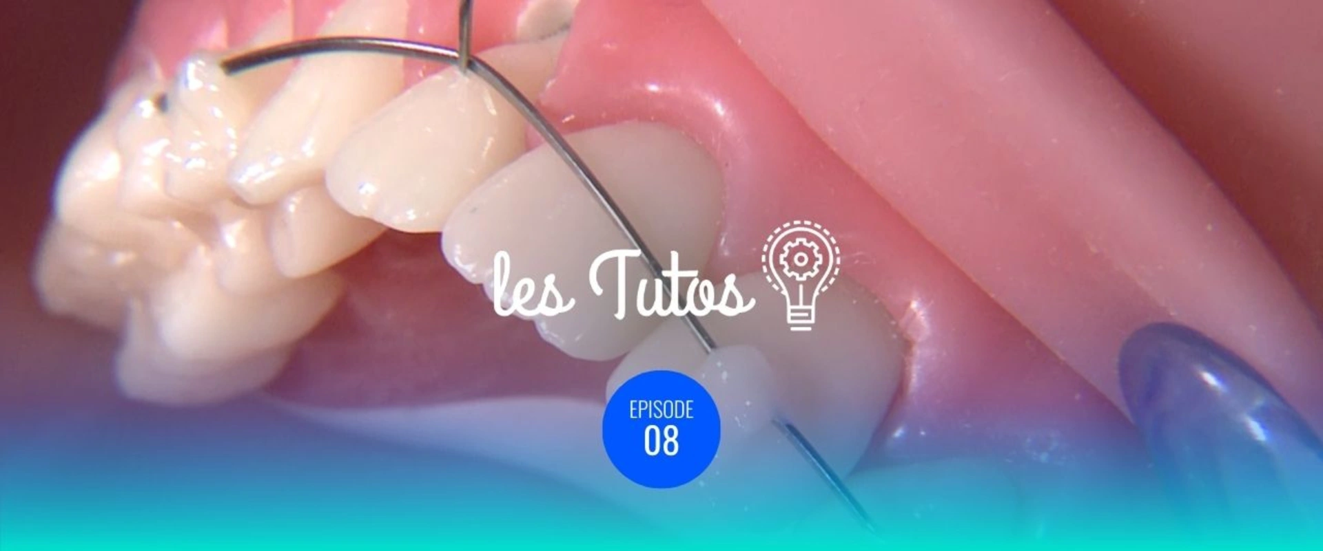 Extrusion orthodontique