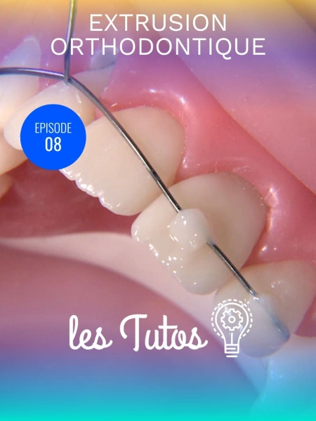 Extrusion orthodontique
