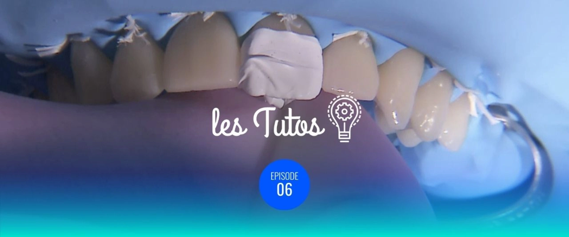 Wax-up et composite moule gestion des usures modérées