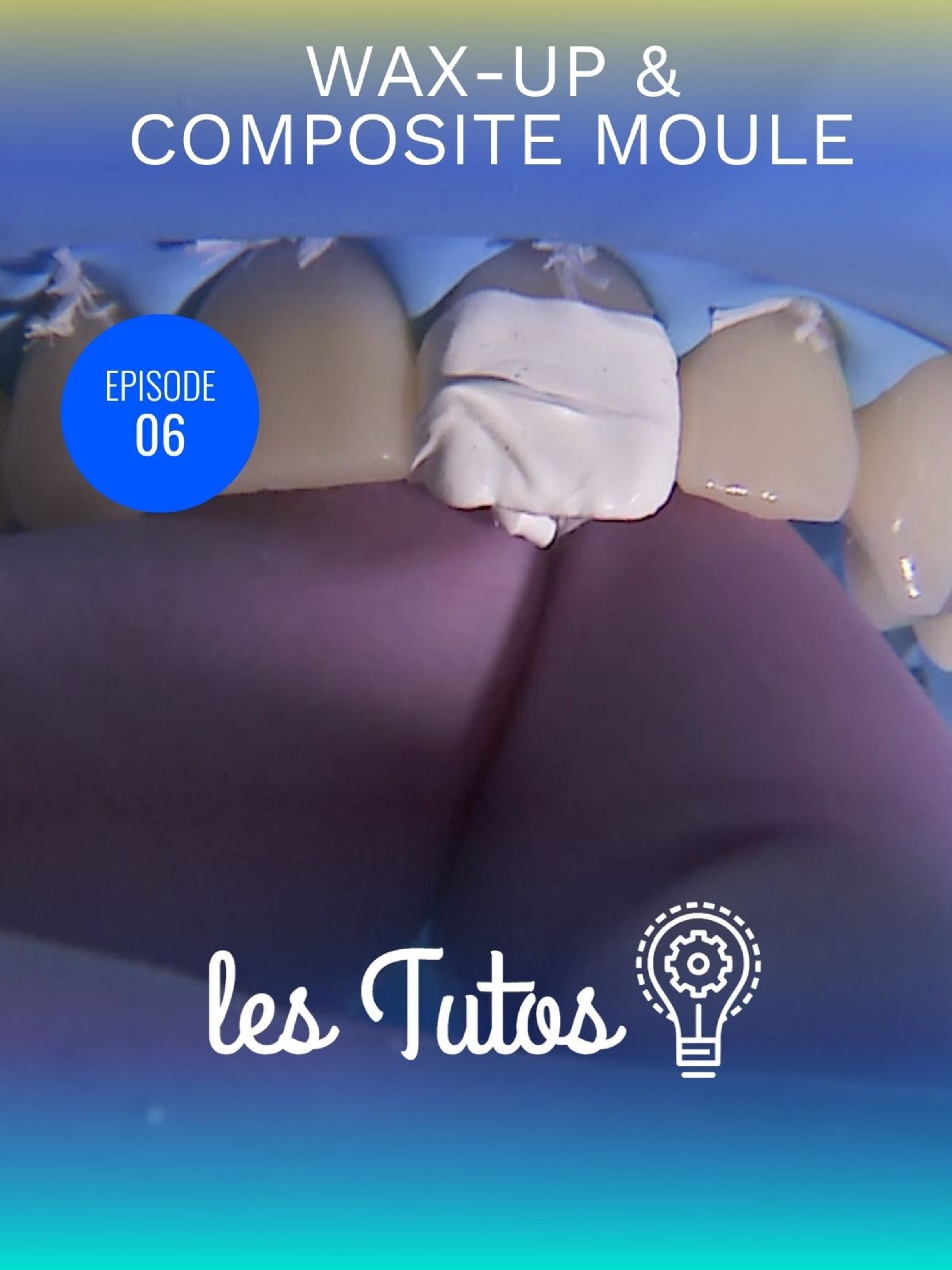 Wax-up et composite moule gestion des usures modérées