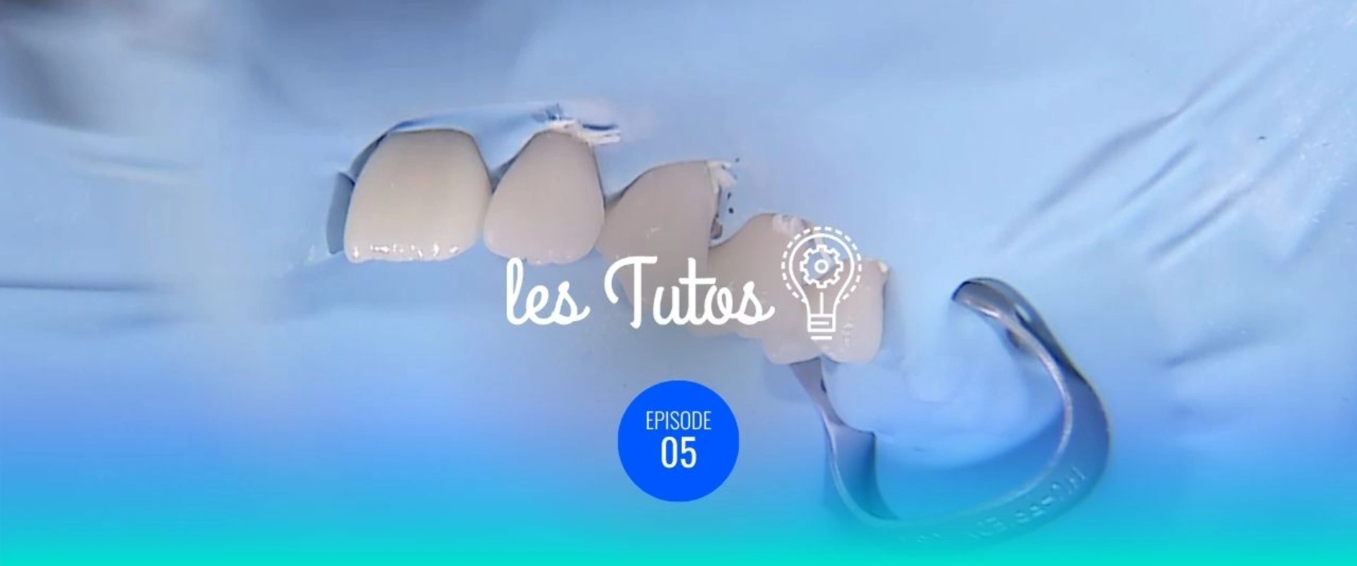 Wax-up et composite moule pour modification morphologique importante