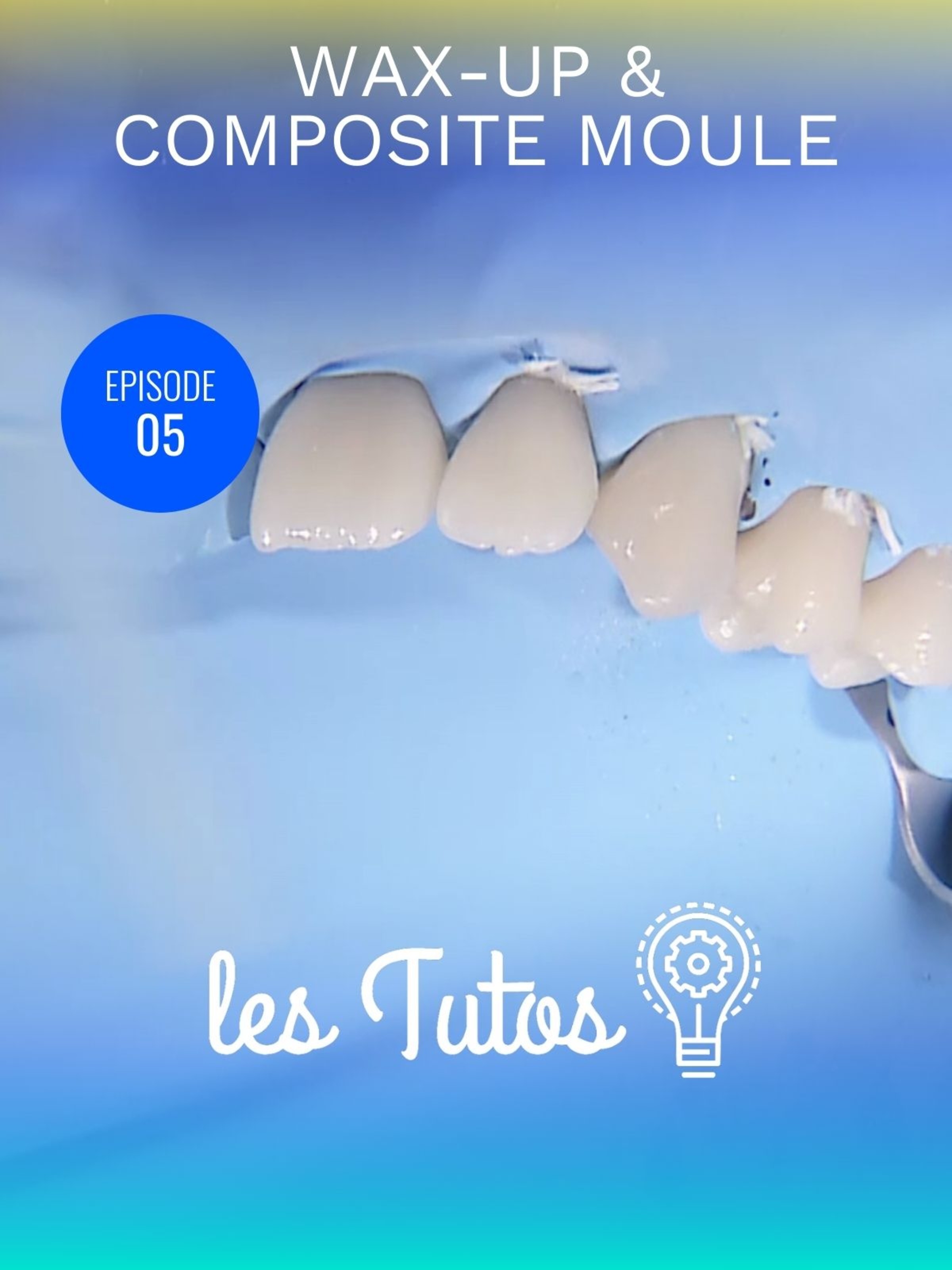 Wax-up et composite moule pour modification morphologique importante