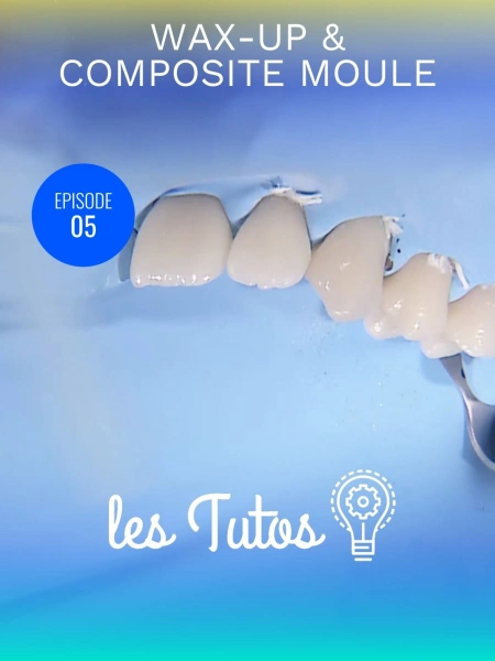 Wax-up et composite moule pour modification morphologique importante