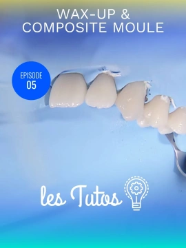 Wax-up et composite moule pour modification morphologique importante