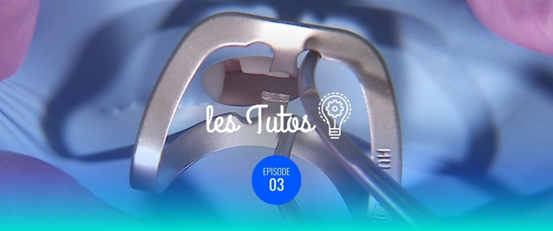 Stabilisation des crampons sur dents préparées prothétiquement