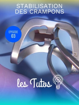 Stabilisation des crampons sur dents préparées prothétiquement