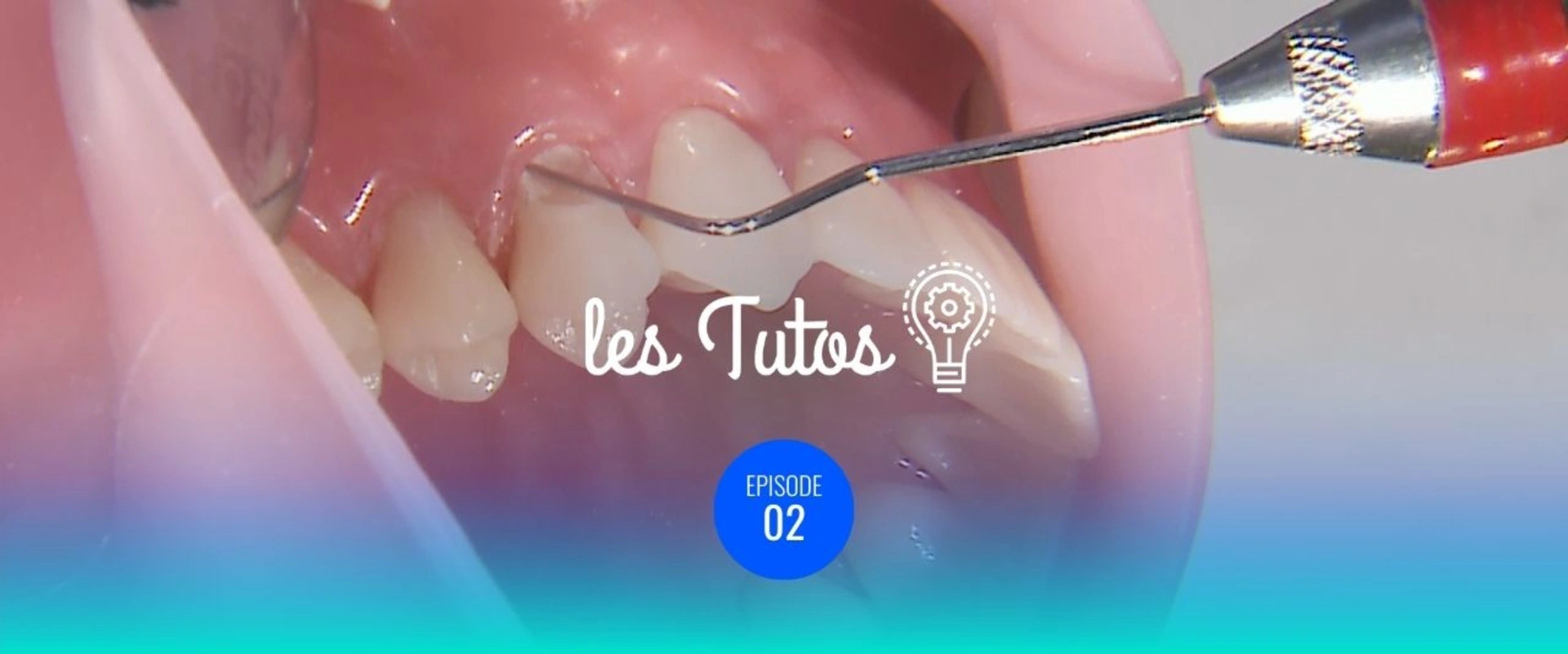 Matrices personnalisées pour restauration de Classe V sous-gingivale