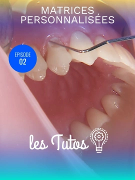 Matrices personnalisées pour restauration de Classe V sous-gingivale