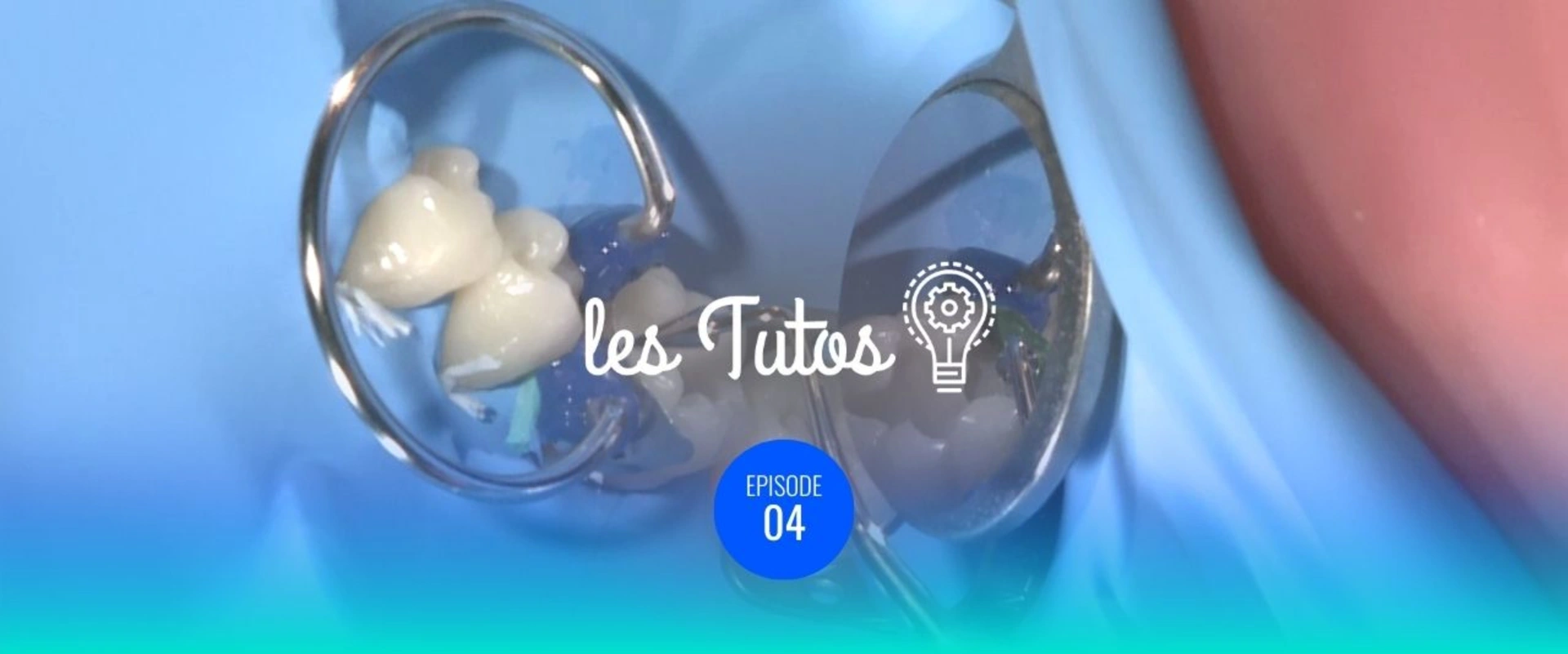 Enregistrement d'une face proximale pour Classe 2