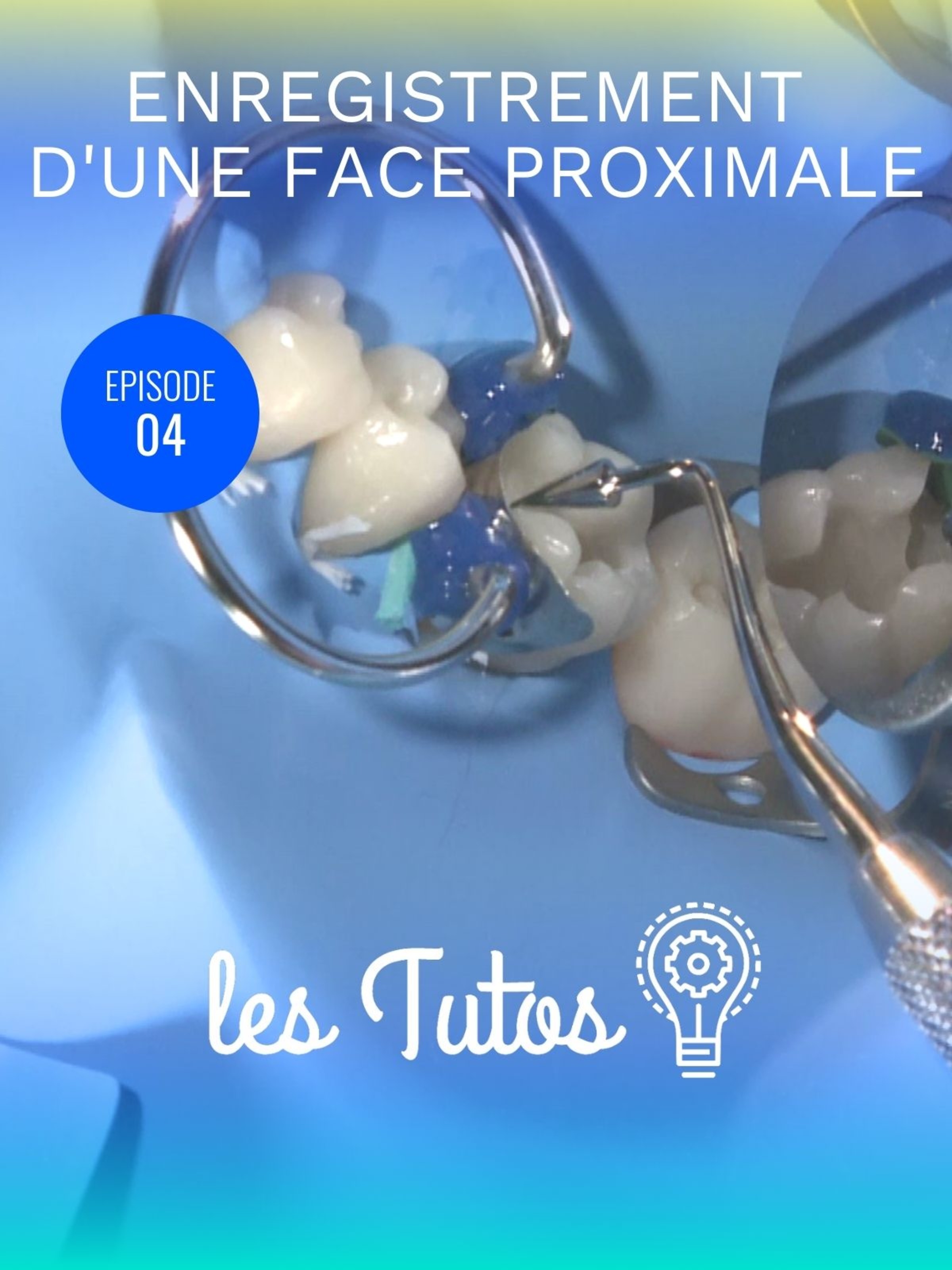 Enregistrement d'une face proximale pour Classe 2