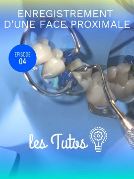 Enregistrement d'une face proximale pour Classe 2