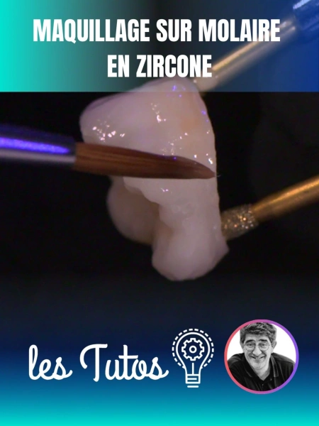 Maquillage sur molaire en zircone