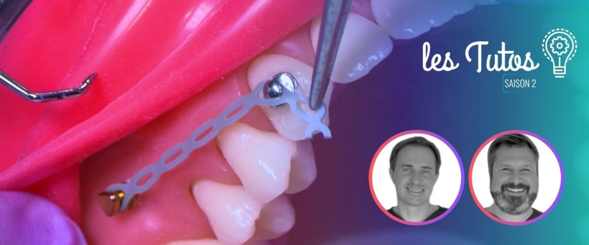 Ortho : Pose d'une mini vis