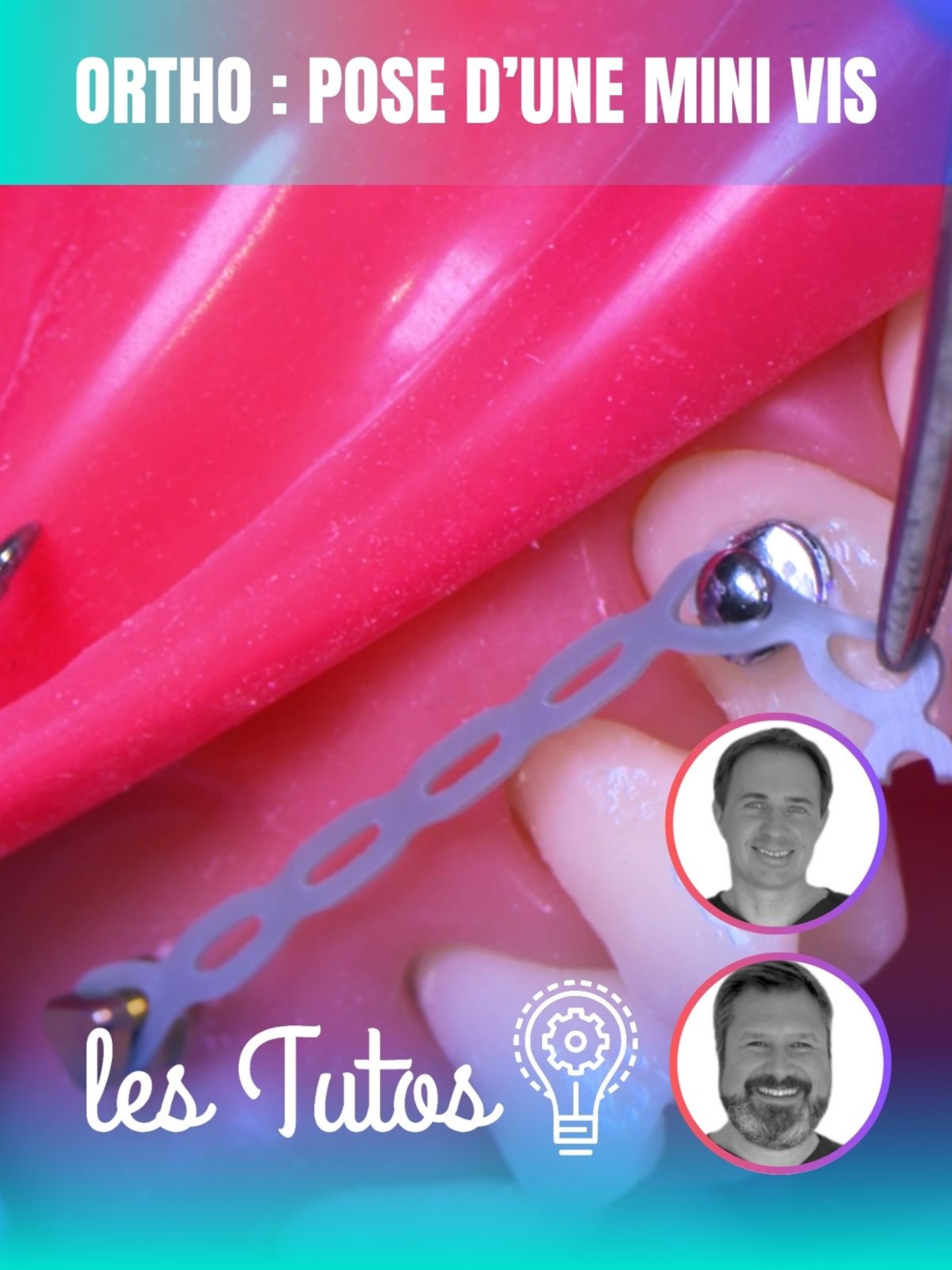 Ortho : Pose d'une mini vis