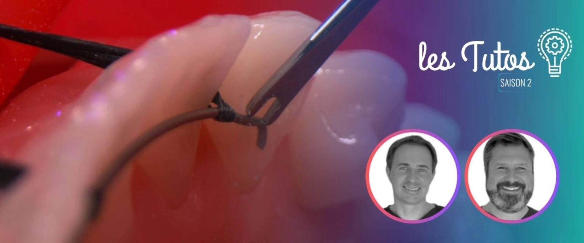 Ortho : Réalisation d'un fil de contention