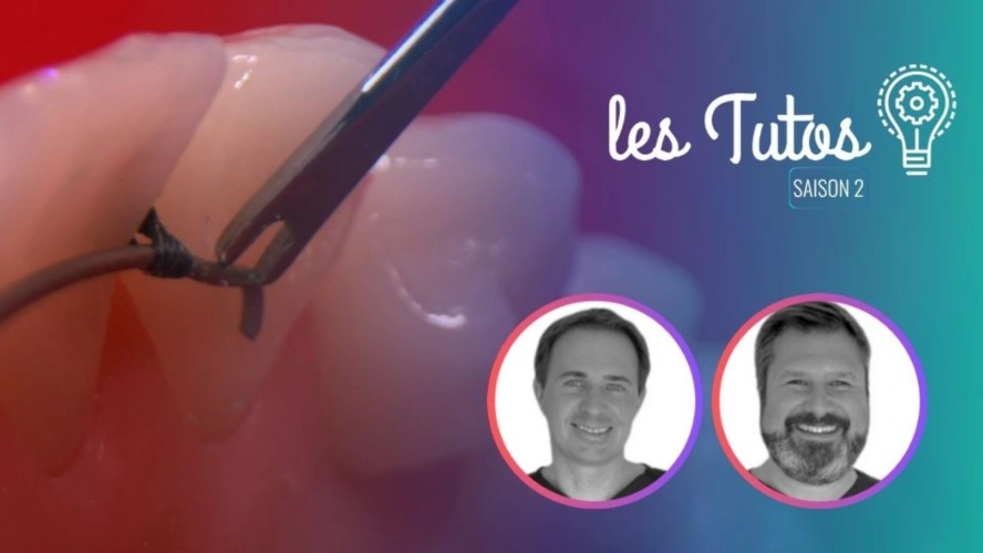 Ortho : Réalisation d'un fil de contention