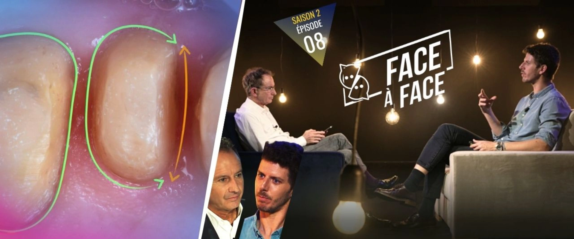 Cette semaine : Verti-Prep, caries profondes