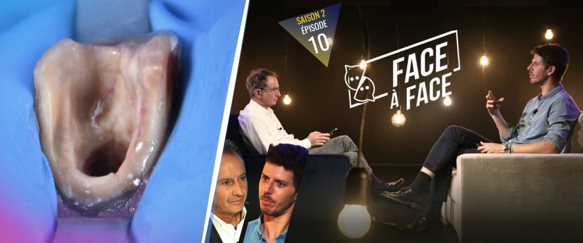 Verti-Prep : reconstruction des moignons