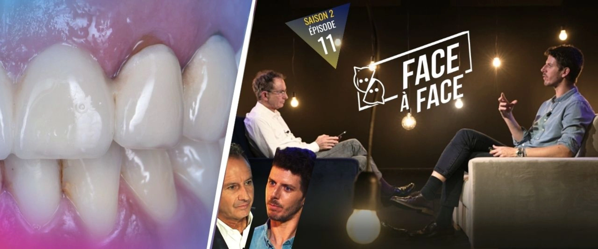 Verti-Prep : Masquer un Inlay-Core