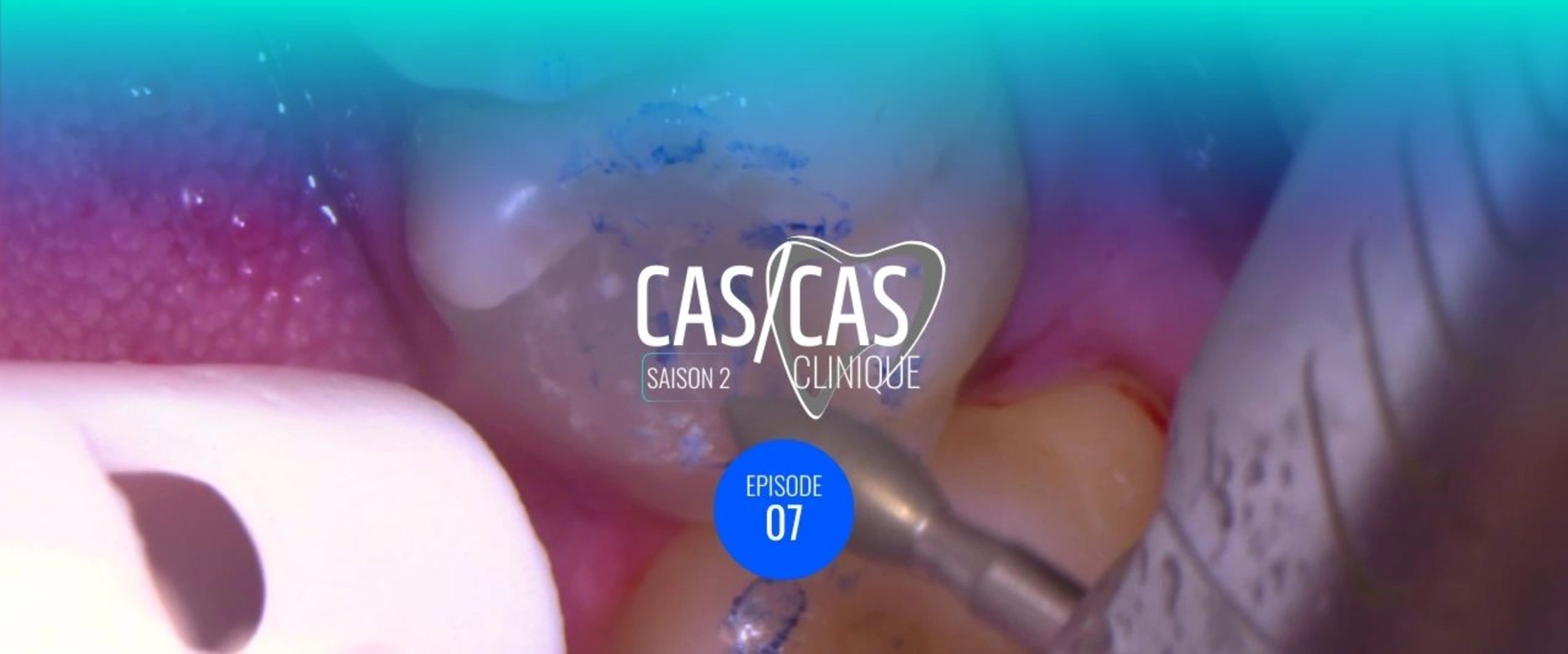 Cas clinique : Préparation Onlay 46