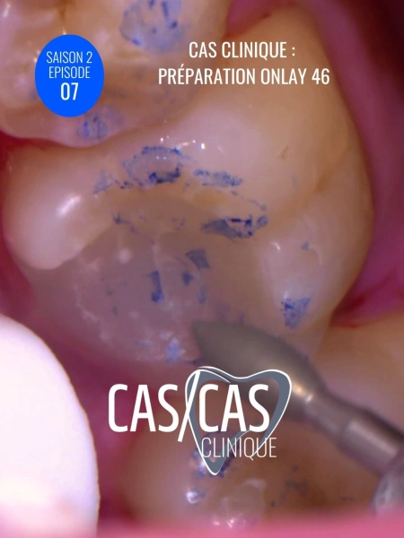 Cas clinique : Préparation Onlay 46