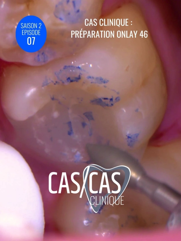 Cas clinique : Préparation Onlay 46