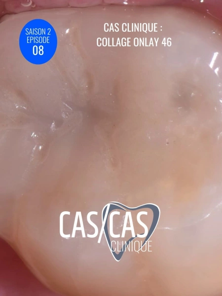 Cas clinique : Collage Onlay 46