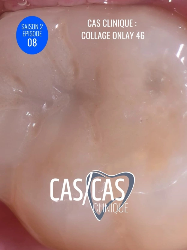 Cas clinique : Collage Onlay 46