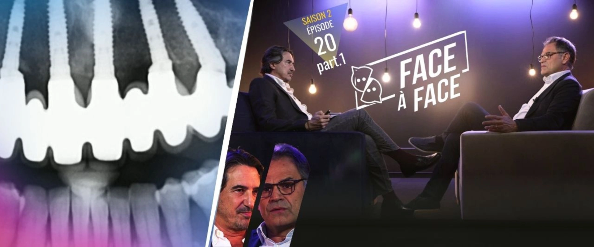 Parodontie : Parodontite sévère : Approches thérapeutiques implantaires