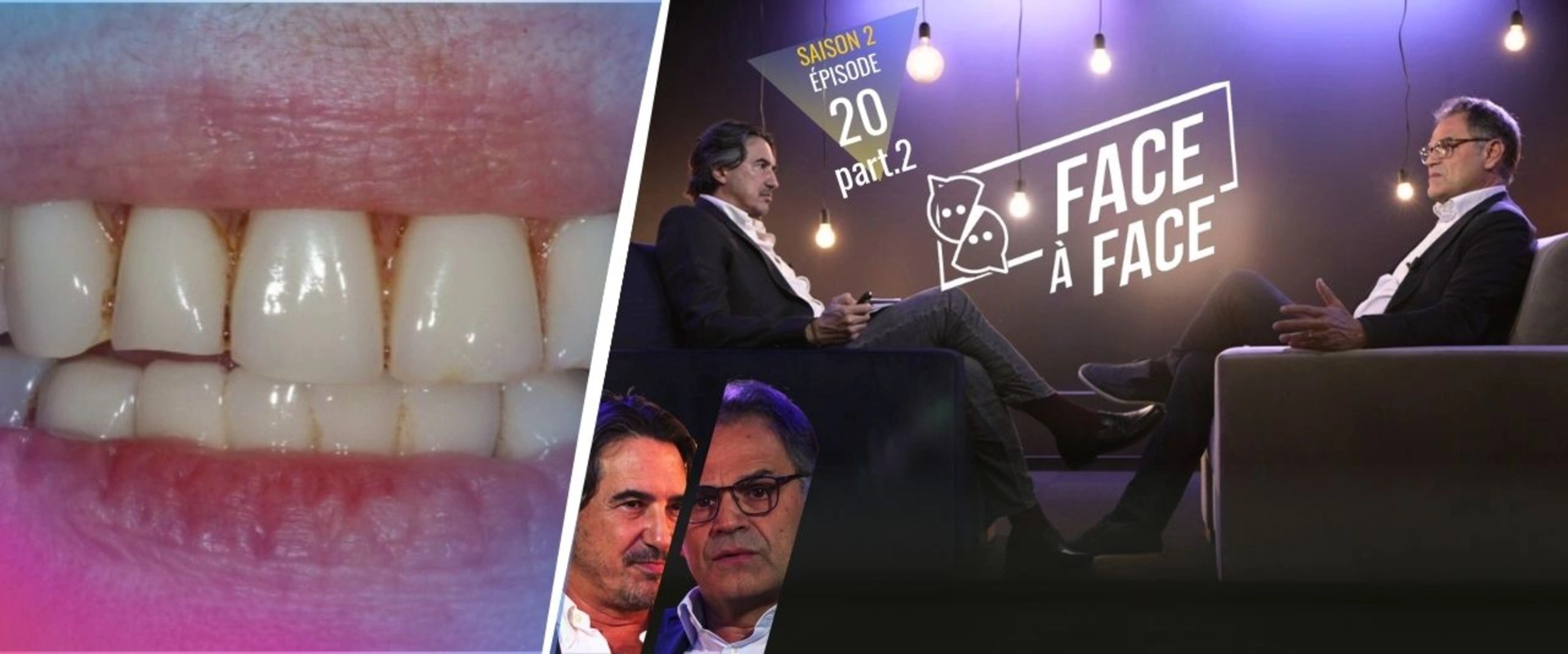 Parodontie : Parodontite sévère : Analyse du sourire