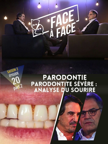 Parodontie : Parodontite sévère : Analyse du sourire