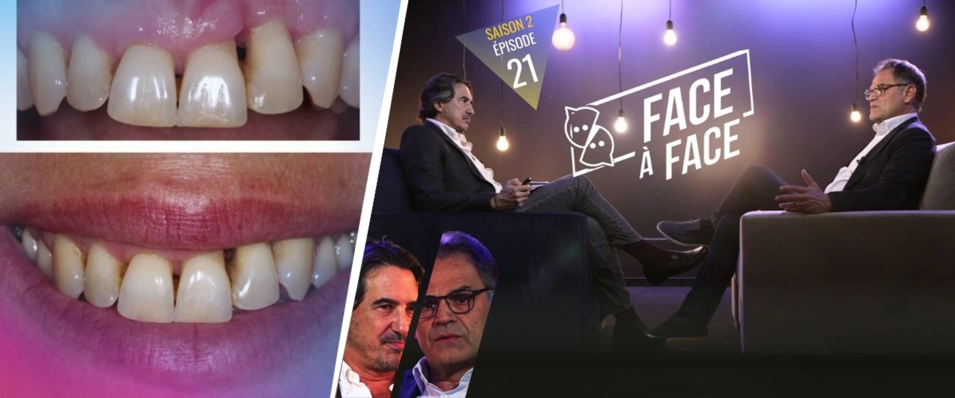 Parodontite sévère et choix thérapeutique : analyse de différents cas