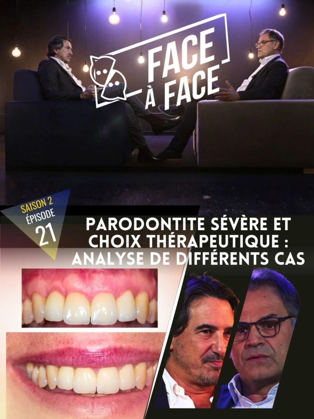 Parodontite sévère et choix thérapeutique : analyse de différents cas