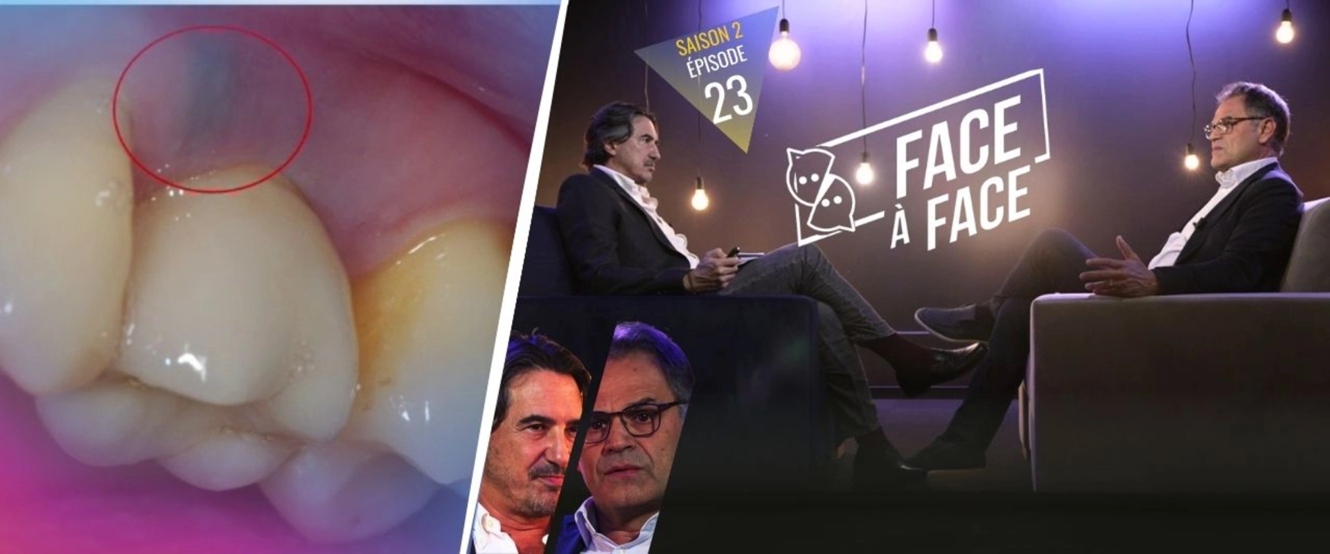 Implantologie : L'étiologie de la péri-implantite