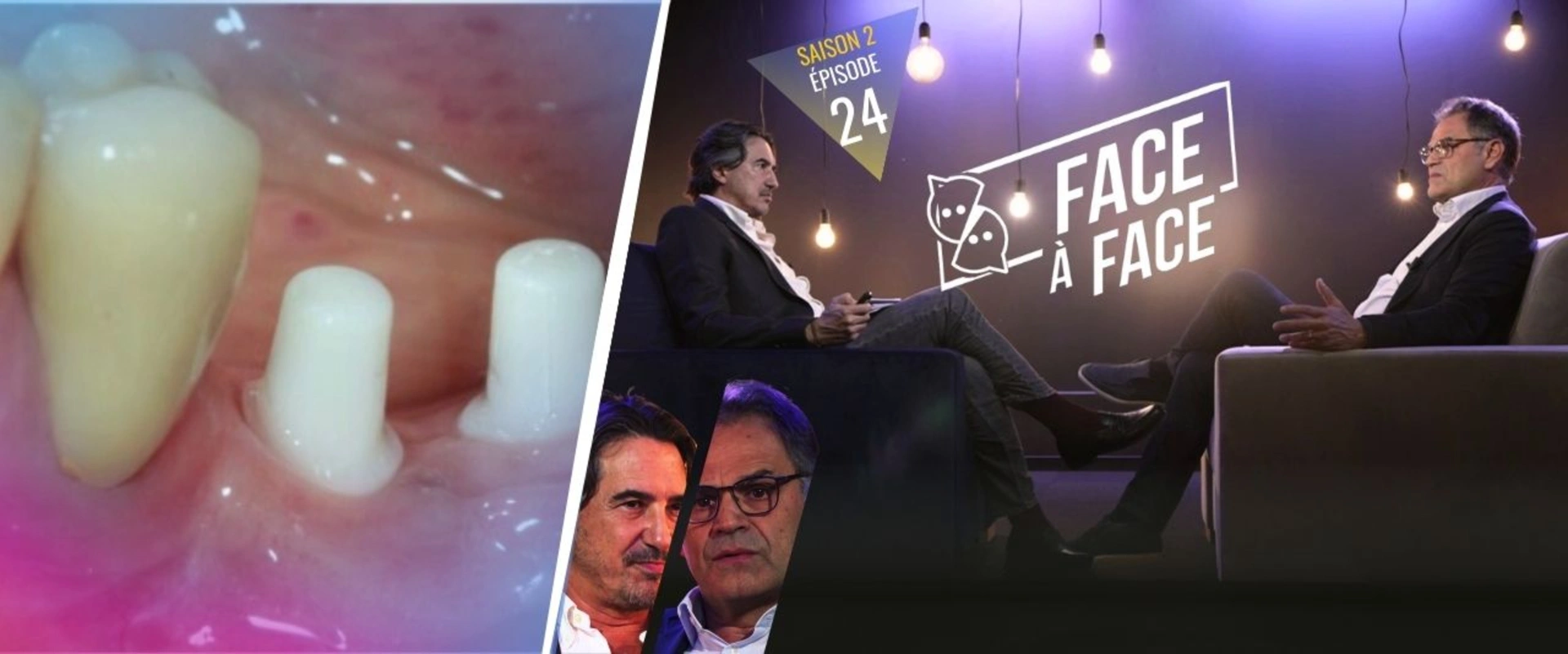 Implantologie : Historique des implants céramique