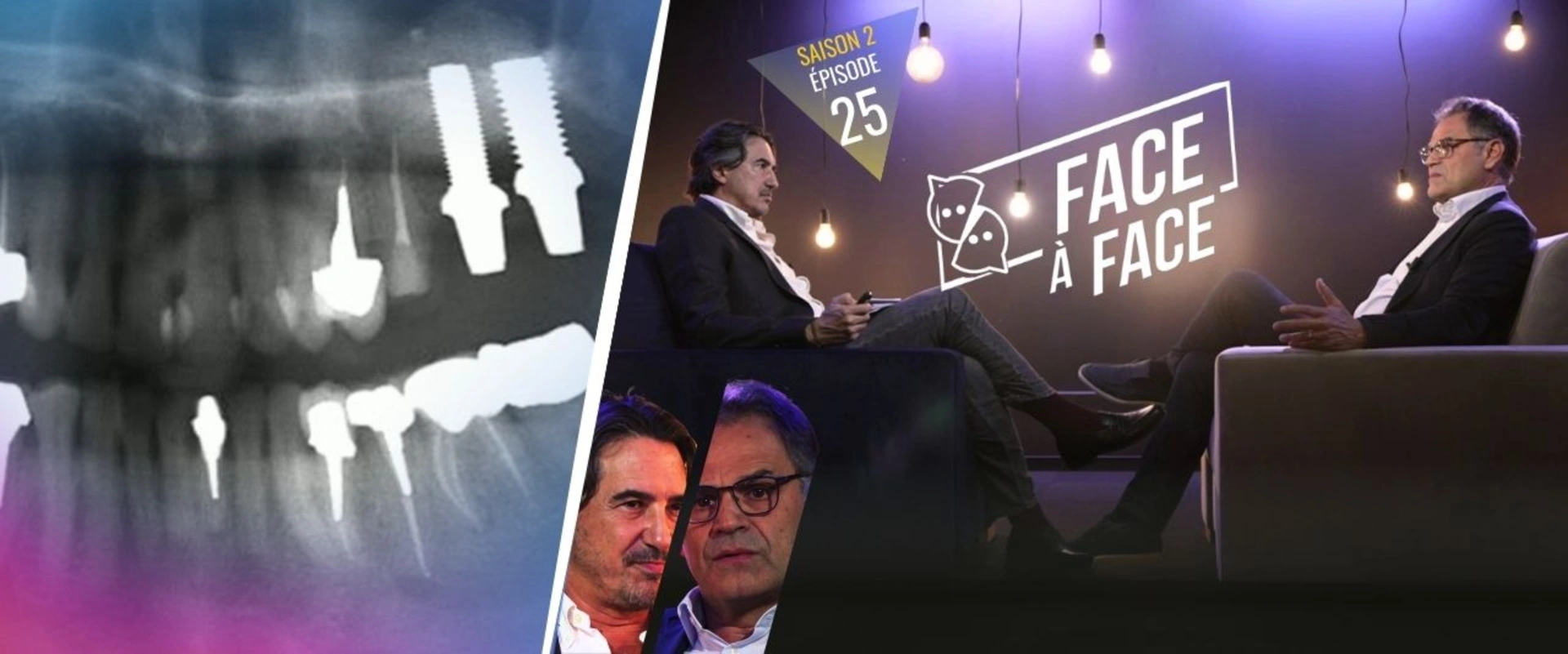 Implantologie : Influence de la zircone sur les risques péri-implantaires