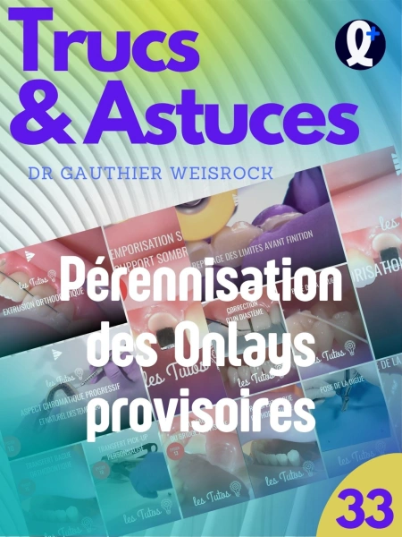 Trucs et astuces : Pérennisation des Onlays provisoires
