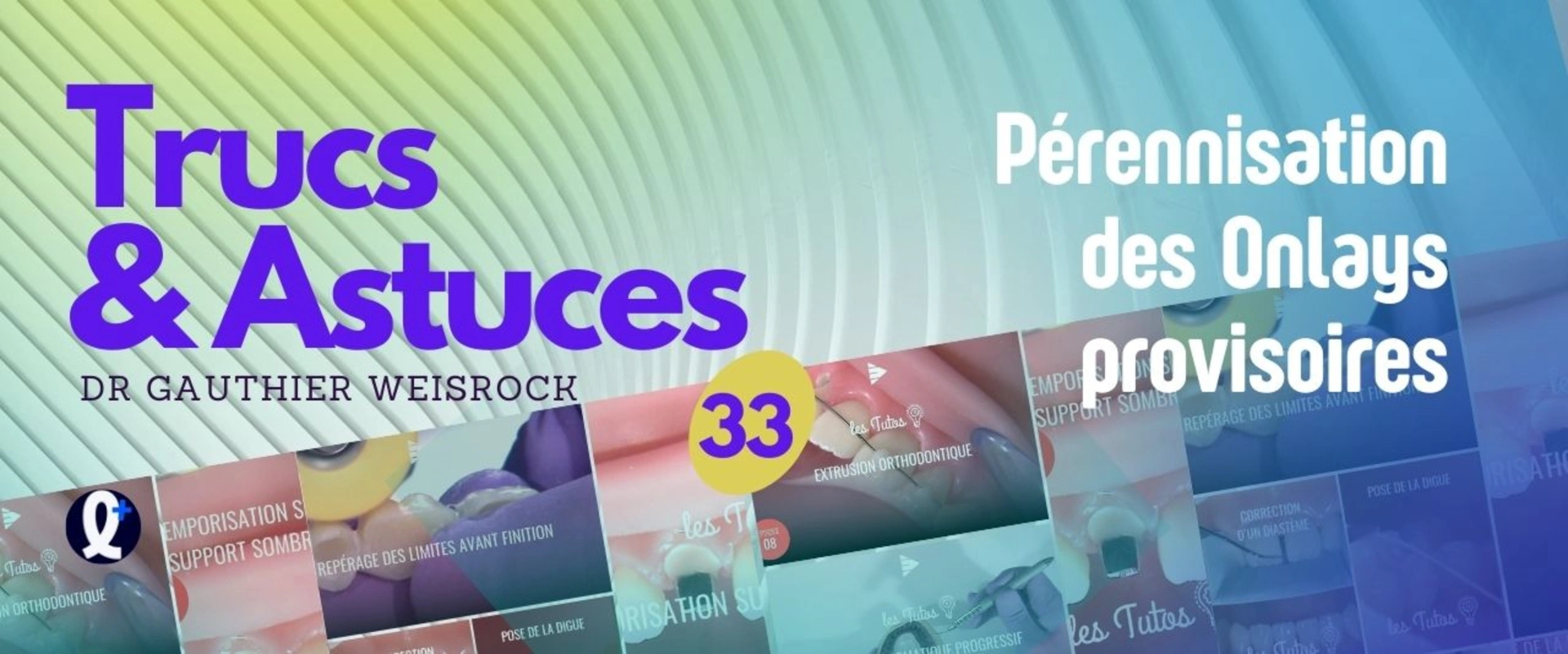 Trucs et astuces : Pérennisation des Onlays provisoires