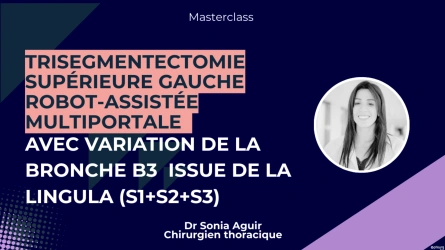 Trisegmentectomie supérieure gauche robot-assistée multiportale avec variation de la bronche B3  issue de la lingula (S1+S2+S3)